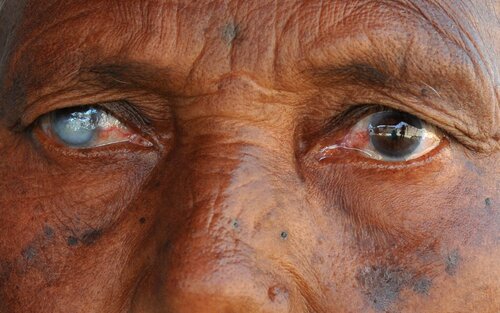 how do blind people eyes look like